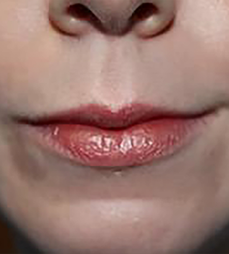 Before & After Lip Enhancement Treatment