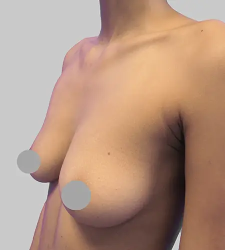 Before & After Breast Augmentation Surgery