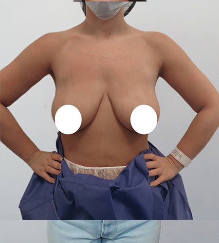 Before & After Breast Uplift Surgery