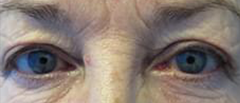 Before & After Eyelid Surgery