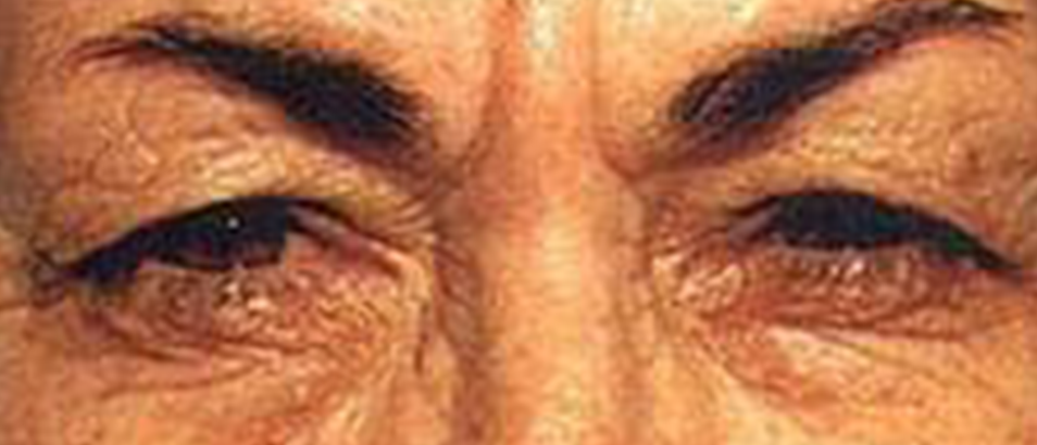 Before & After Eyelid Surgery