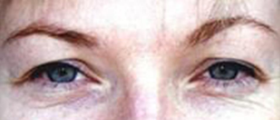 Before & After Eyelid Surgery