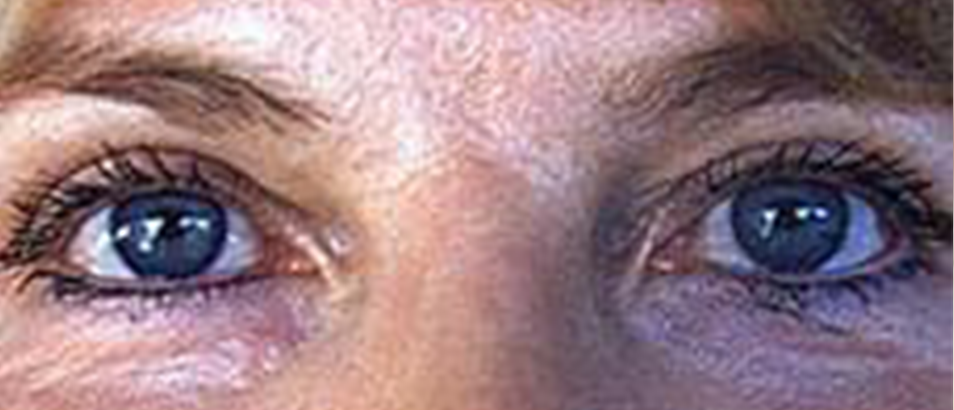 Before & After Eyelid Surgery
