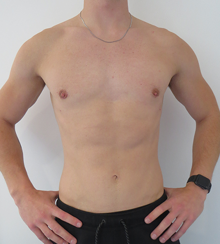Before & After Breast Reduction Surgery