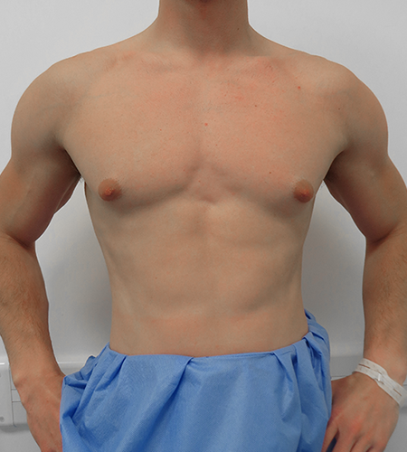 Before & After Breast Reduction Surgery