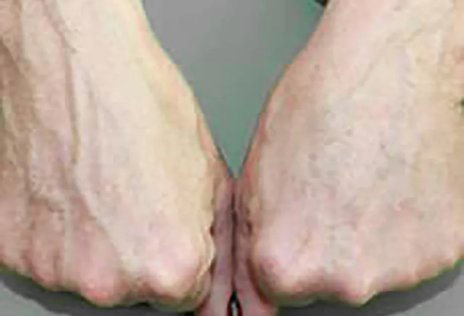 Before & After Hand Rejuvenation Treatment