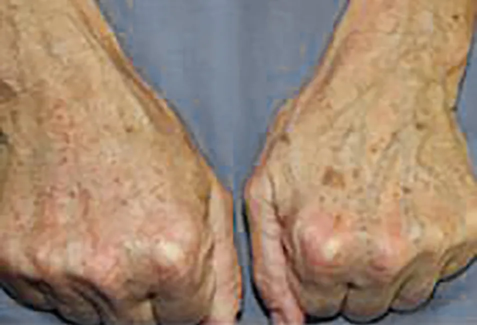 Before & After Hand Rejuvenation Treatment