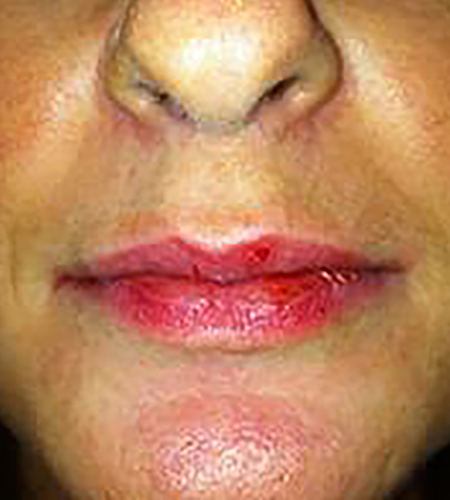 Before & After Lip Enhancement Treatment