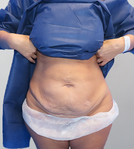 Before & After Tummy Tuck Surgery