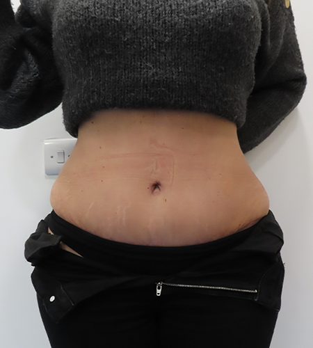 Before & After Tummy Tuck Surgery