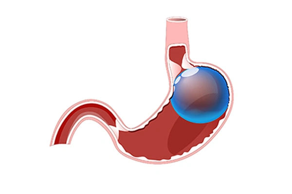 Gastric Balloon Surgery Preparation